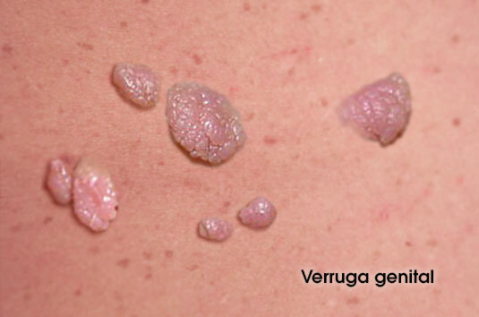 Se desarrolla la vacuna contra el virus del papiloma humano