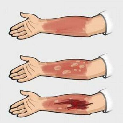 Timeline: TRATAMIENTOS DE LAS QUEMADURAS