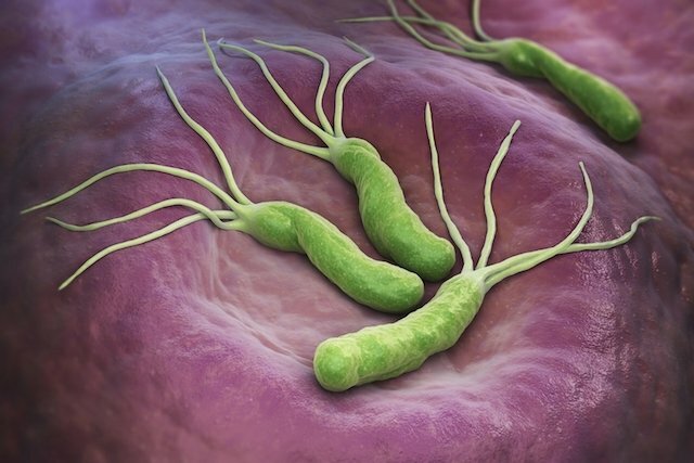 Helicobacter pylori como causa de ulcera gástrica