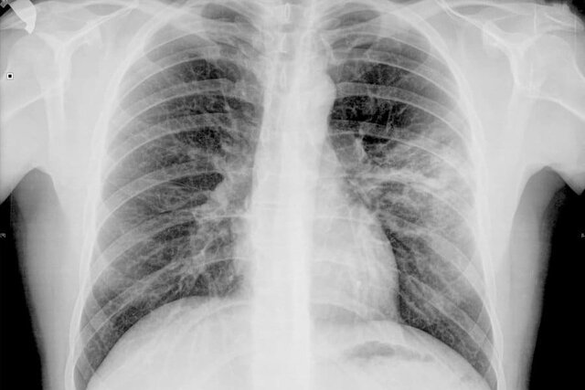 Aparece en China la neumonía atípica