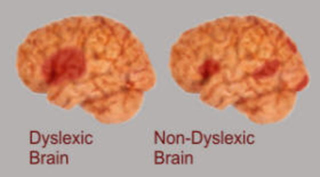 Autopsy Reveals a Lesion of Left Posterior Hemisphere