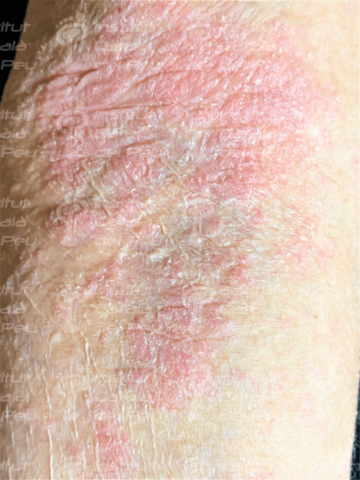 Lesiones por radiación