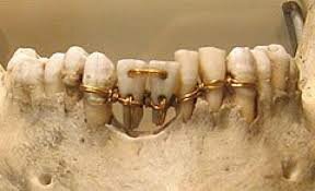 Implantes dentales
