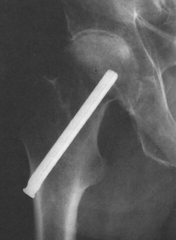 Aplicación de prótesis