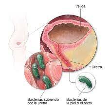 infección urinaria en el hombre