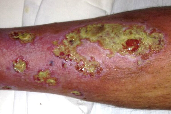 la teoría microbiana