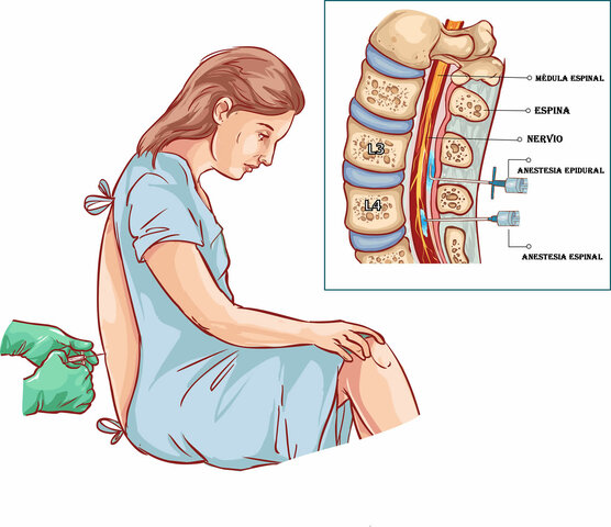 ANESTESIA EPIDURAL