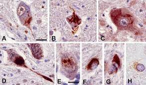 LA TEORÍA MICROBIANA SIN PASTEUR Y KOCH