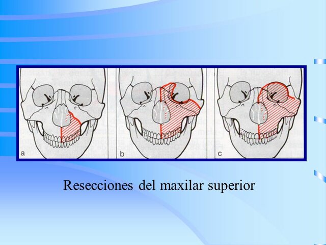 RESECCIÓN DE MAXILAR SUPERIOR