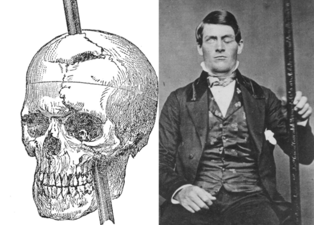 El extraño caso de Phineas Gage 1848