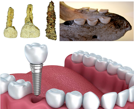 Implantes dentales