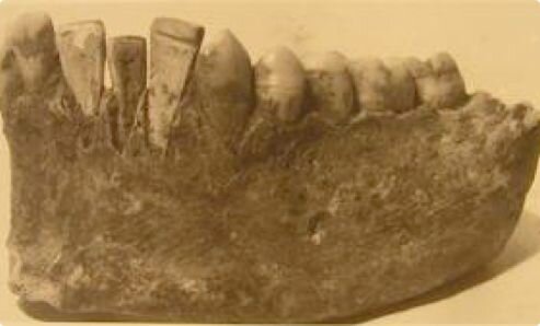 Primeras prótesis dentales