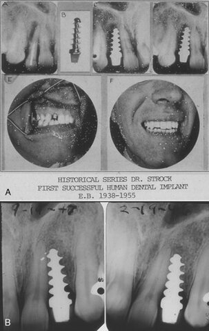 Invención del Vitallium