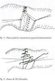 La ligadura de los vasos con hilo de lino en Alejandría