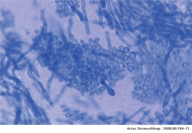 Pitiriasis Versicolor