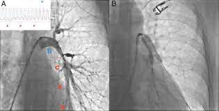 ANDREAS GRUNTZIG INICIA LA RADIOLOGIA 	Y 	LA 	CARDIOLOGIA INTERVENCIONISTAS.