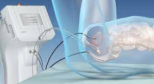 Radiación  ionizante en terapia