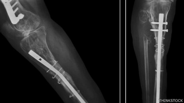 Tornillos de carbón