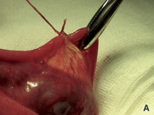 Primera Estirilización Tubárica