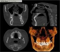 tomografia cone-beam