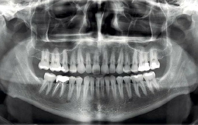 Ortopantomografía Convencional