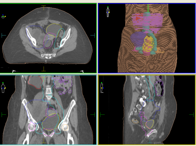 •	Aplicaciones desde 1895 hasta nuestros días de la radiación ionizante en terapia