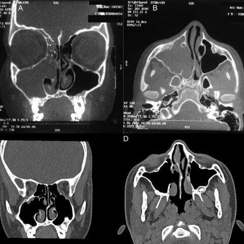 Tomografía computarizada (1990)