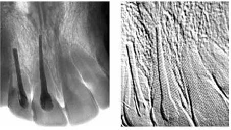 Primer implante Exitoso