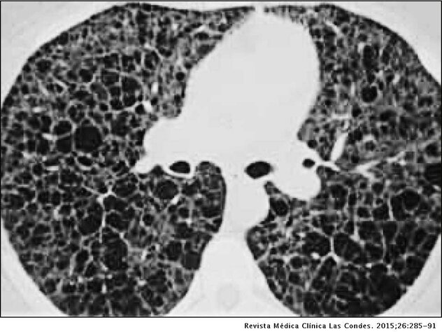 Variedad de enfermedades pulmonares difusas