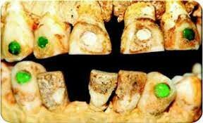 LIMADURAS E INCRUSTACIONES