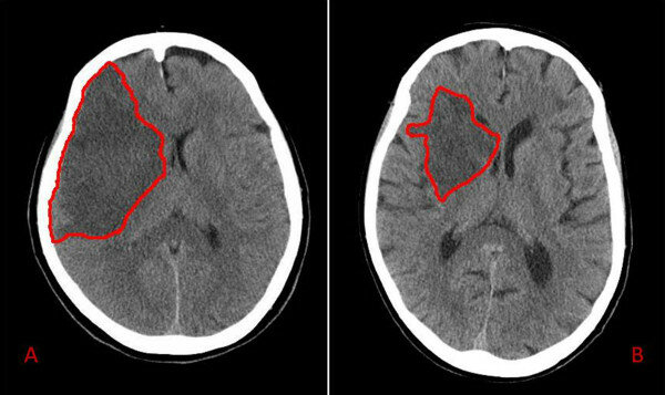 Diagnosticar un Ataque cerebrovascular