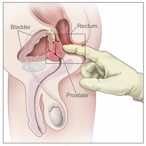 Prostate Cancer Screening (Yearly)