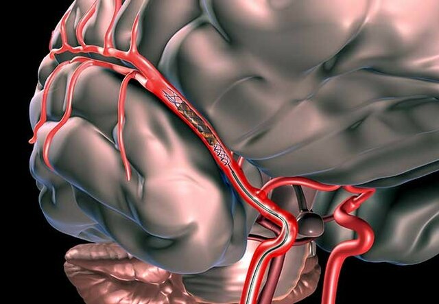 trombectomía mecánica