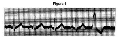 ELECTROCARDIOGRAMA
