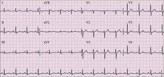 Invención del Electrocardiograma