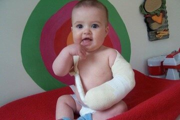 Tuve cirugía en el brazo