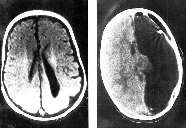 Primer cirugía de epilepsia
