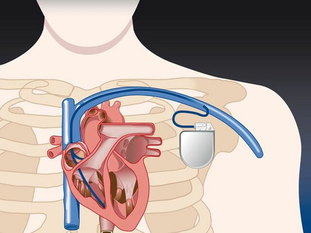 Primeros usos de los marcapasos