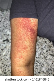 Fiebre Chikungunya en la Americas