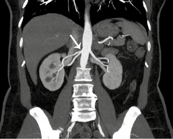 1979 - Proyección de intensidad máxima