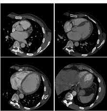 1980 - Quinta Generación