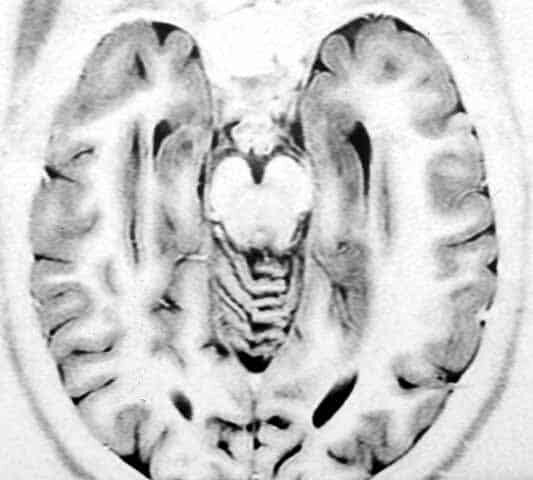 Primera cirugía de epilepsia