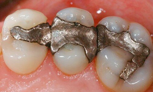 Empastes dentales con amalgama de Plata-Mercurio