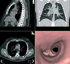 TAC Multicorte de 64 cortes