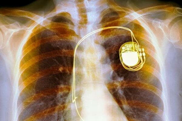 Marcapasos externos.