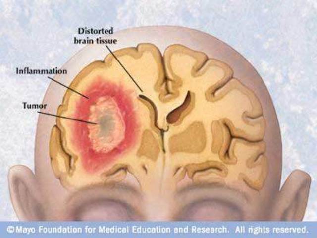 Brain Tumor