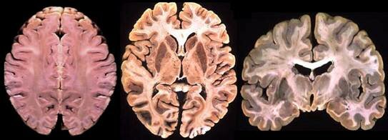 Disección del cerebro