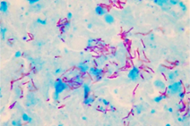 Tinción de Ziehl-Neelsen