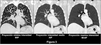 1989-Proyeccion de intensidad máxima