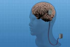 Cirugía epiléptica